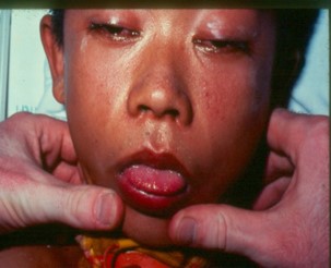 Hình.C.16: Dấu hiệu sụp mi, mắt đứng tròng ở trung tâm, liệt mềm, cân đối do nọc rắn Hổ.