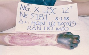 Hình.C.19: BN bị hoại tử cánh tay lan sâu-rộng do nọc rắn hổ mèo, tại BV Chợ Rẫy.