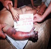 Hình.C.21: Xuất huyết toàn thân do nọc rắn CQ