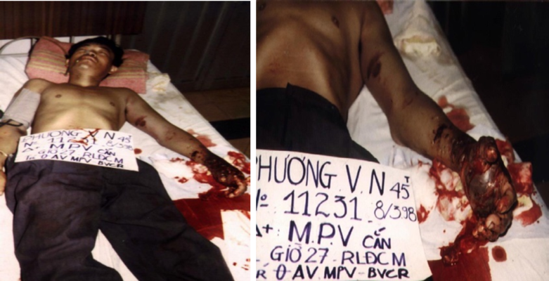 Hình.C.30: BN NV.Ph bị nhiễm độc nọc rắn CQ nhập BV Chợ Rẫy, 1998.
