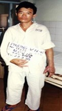 Hình.C.31:  BN NV.Ph hồi phục hoàn toàn sau điều trị bằng HTKN tại BV Chợ Rẫy, 1998.