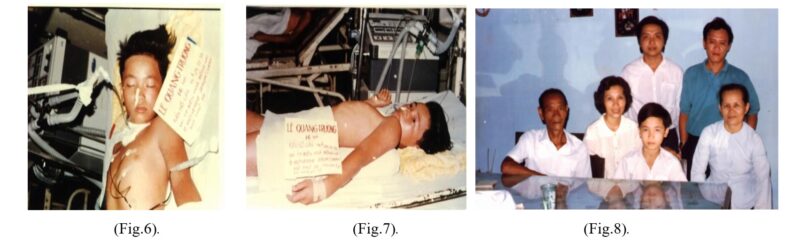 Le Q T, the first snakebite victim was severely envenomed by NK venom (Fig.6). He recovered by N.K AV treatment at CR hospital (Fig.7). and His family.1991(Fig.8).