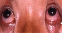 Fig.20: Patient with bilateral conjunctivitis due to Naja siamensis Fig.21: Patient with deep-wide arm necrosis due.